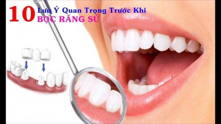 10 vấn đề cần khắc cốt ghi tâm trước khi bọc răng sứ